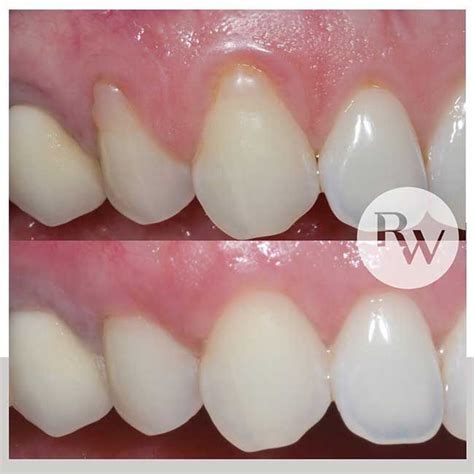 Gingival Graft Before And After