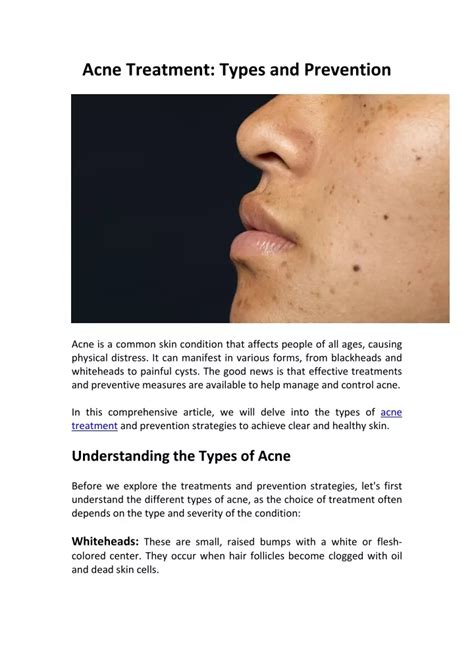 Ppt Acne Treatment Types And Prevention Powerpoint Presentation Free Download Id 12492897