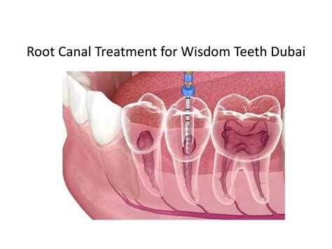 Ppt Root Canal Treatment For Wisdom Teeth In Dubai Powerpoint