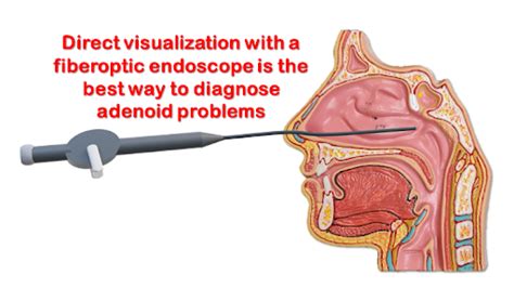 Enlarged Adenoids, Adenoiditis and Adenoid Surgery in Children