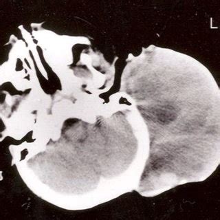 Photomicrograph Showing Nodules Of Tumor Cells Separated By Hyalinised