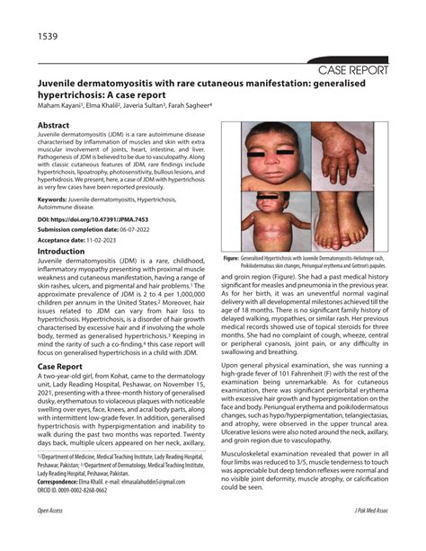 PDF Juvenile Dermatomyositis With Rare Cutaneous Manifestation