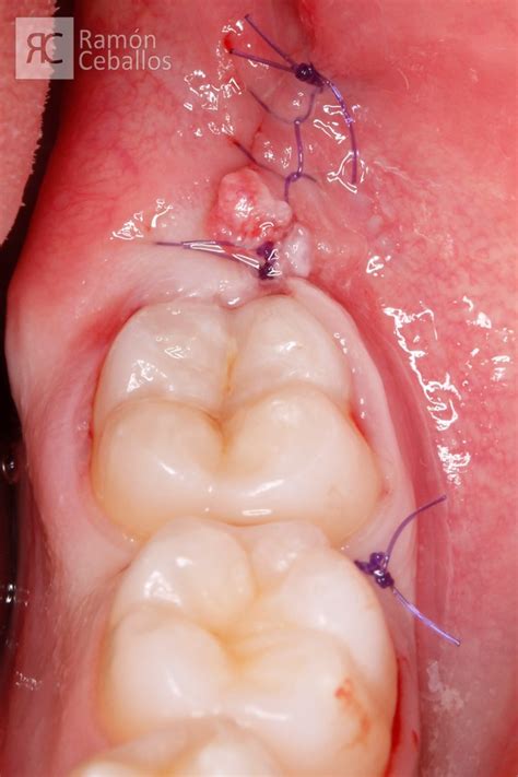 Extracci N Quir Rgica De Un Cordal Completamente Horizontal Dr Ram N