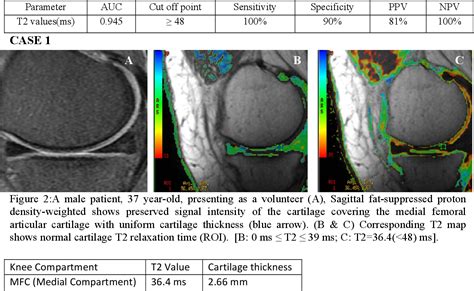 Figure From Role Of Mri T Mapping In Assessment Of Articular Knee