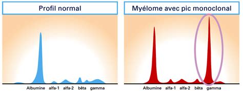 Que signifie la présence d une immunoglobuline monoclonale Examens