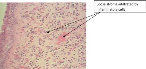 Antrochoanal Polyp Histology