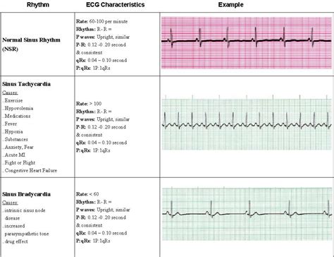 Acls Ekg Rhythms