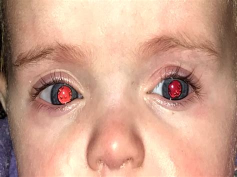 Figure Congenital Cataracts Peripheral Lenticular Opacities