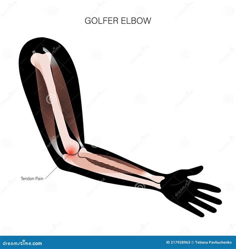 Medial Epicondylitis Golfer Elbow Vector Illustration | CartoonDealer