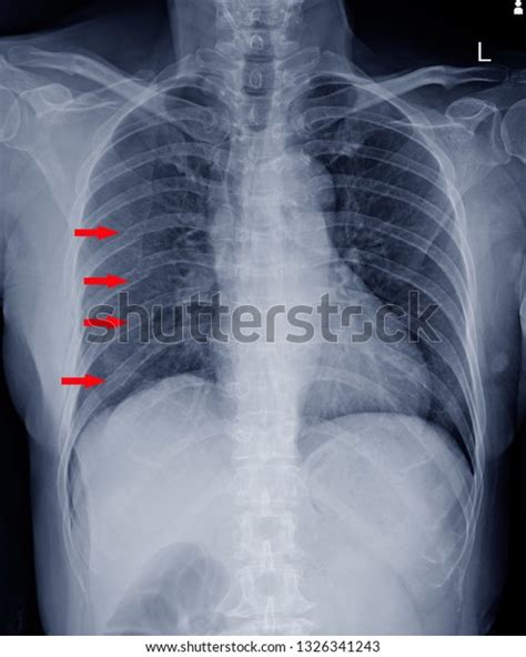 1,697 Fracture Rib Stock Photos, Images & Photography | Shutterstock