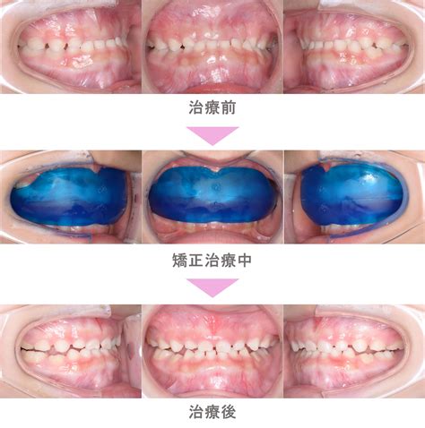 プレオルソ（予防矯正）の症例紹介｜受け口（反対咬合）の症状｜非抜歯による矯正治療｜治療期間は2か月（狛江市・4歳女児 ） インビザライン