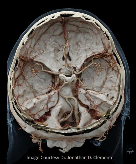 Anterior Cerebral Artery