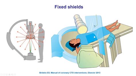 How To Reduce Radiation Dose During Cardiac Catheterization YouTube