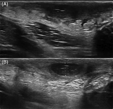 A Ultrasonographic Appearance Of A Large Inguinal Abscess At Baseline Download Scientific