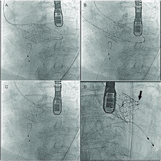 Deployment Of The Amplatzer Vascular Plug II Shown With Fluoroscopy