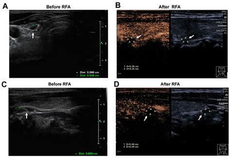 Changes Of Two Left Parathyroid Glands Before And After Rfa By Neck