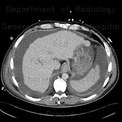 Radiology Case Liver Cirrhosis Ascites Portal Colonopathy Colopathy