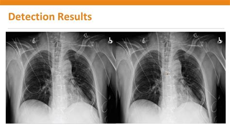 Carina Lung Xray