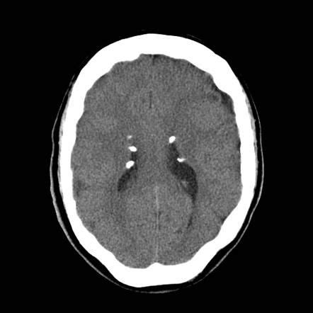 This Patient Has Characteristic And Near Pathognomonic Features Of