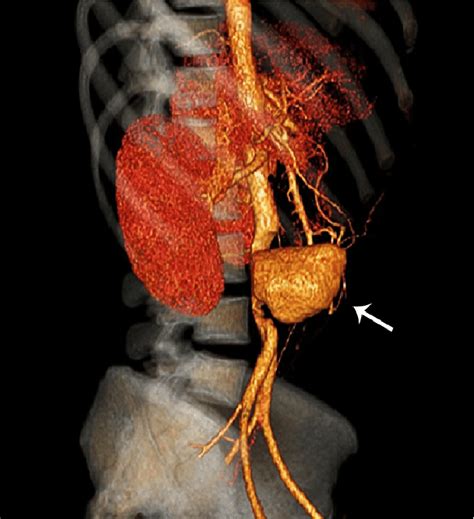 Aortic angiogram CT revealed an infrarenal aortic saccular aneurysm ...