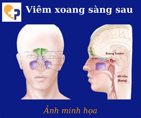 Cách chữa bệnh viêm xoang sàng sau