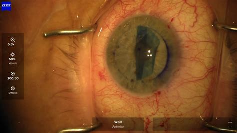 Routine Dmek Surgery Lamellar Corneal Transplant Step By Step Hd