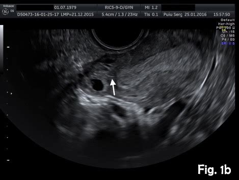 Ultrasound diagnosis of uncomplicated interstitial pregnancy [May 2016 ...