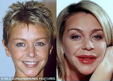 Leslie Ash Plastic Surgery Before And After Photos