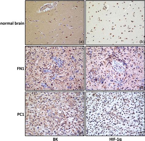 BK Channels Expression In GBM Hypoxic Areas Immunohistochemistry Shows