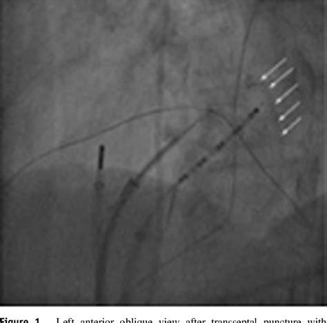 Figure From Transseptal Puncture Facilitated By Reverse Tenting