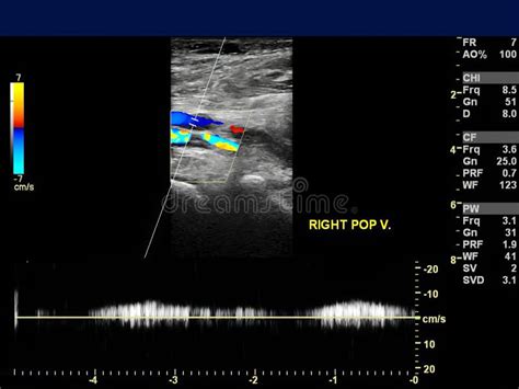 Ultrasound Doppler of Popliteal Vien for Finding Deep Vein Thrombosis ...