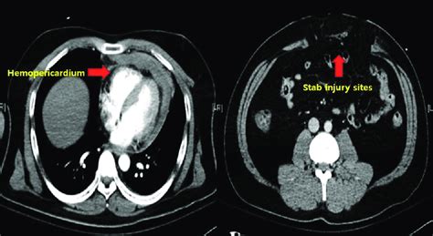 Computed tomographic scan, showing hemopericardium and abdominal injury ...