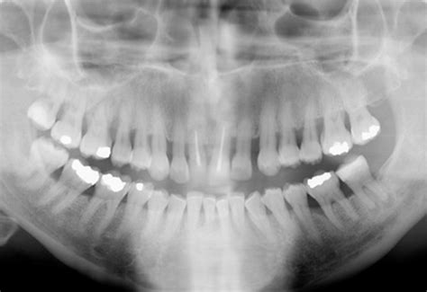 Periodontal Disease - Henderson Periodontics & Implants