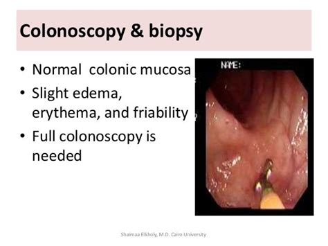 Microscopic Colitis