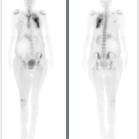 Bone Scintigraphy Demonstrates Tc 99m Methylene Diphosphonate Mdp