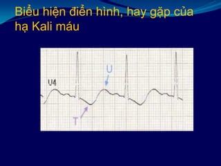dien tam  trong roi loan dien giai