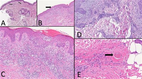 Histopathological Observations In Covid A Systematic Review