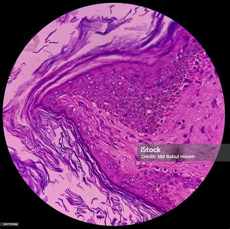 Mature Cystic Teratoma Ovarian Cyst Biopsy Show Cyst Wall Of Skin And