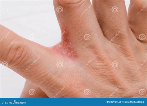 Mano Con Dermatitis Interdigital Eccema Disidrotico En Mano Cerca Foto