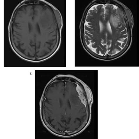 A Axial T Weighted Brain Mri Image In Shows An Iso Intensity In