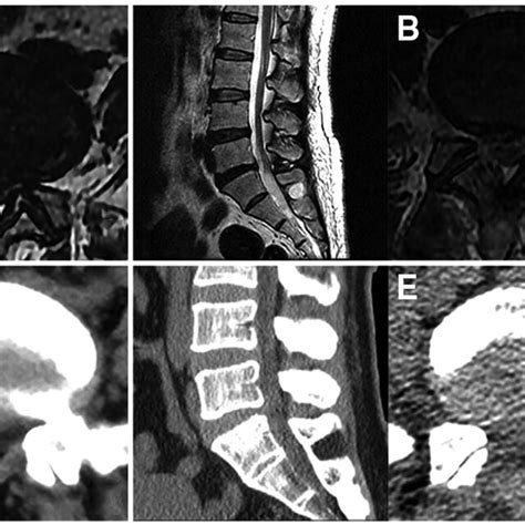 Images Of A Patient Who Underwent Percutaneous Endoscopic Lumbar