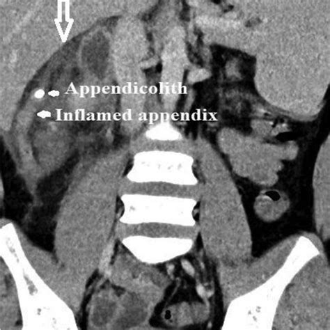 CT Scan Showing Inflamed Appendix In Subhepatic Location With An