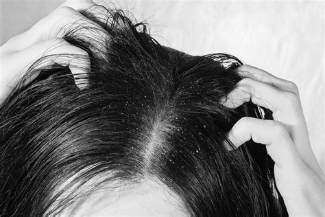 Keratolytic And Hydrating Shampoo Improves Signs Of Scalp Psoriasis