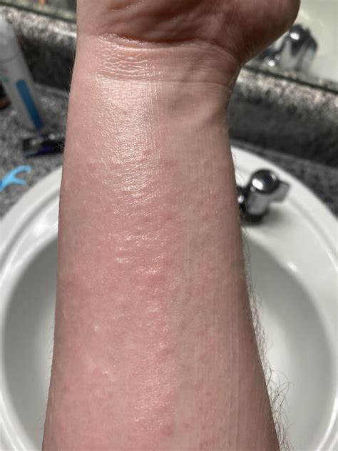 Bumps On Arm R Dermatologyquestions