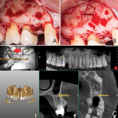 Endodontic Microsurgery Of An Anatomically Challenging Zone Using Dynamic Navigation A Case Report