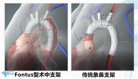 Fontus分支型术中支架系统首次亮相河南主动脉外科战场 患者 治疗 手术