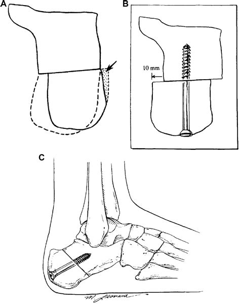 Management Of The Malunited Triple Arthrodesis Foot And Ankle Clinics