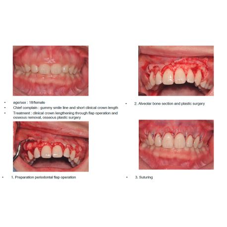 Ora-Aid Intra oral dressing