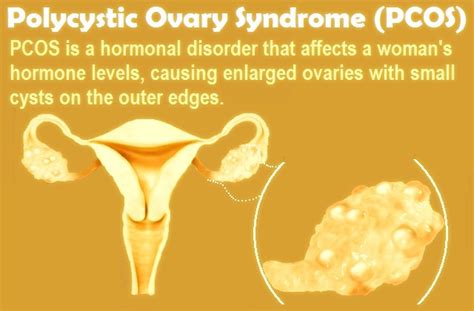 What Is Polycystic Ovary Syndrome Pcos Symptoms Causes And