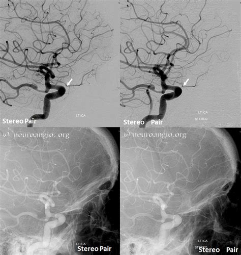 Ophthalmic Artery